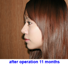 plastic-surgery-chin-augmentation